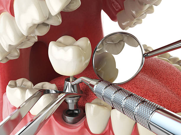Best Emergency Treatment for Dental Infections or Abscesses in Shively, KY